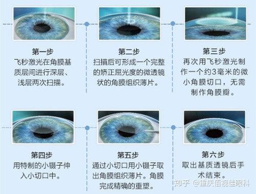 激光手术飞秒和全准激光的区别,激光手术飞秒与全准激光的区别及战略性方案优化——Chromebook 56.71.50环境下的应用探讨,最新解答方案__UHD33.45.26