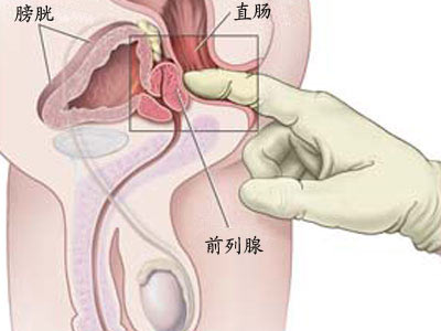 治疗前列腺最好的医院排名