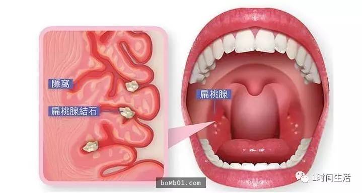 咽炎怎么治 偏方大全,关于咽炎治疗，有效偏方大全及迅速处理解答问题的方法,互动策略评估_V55.66.85