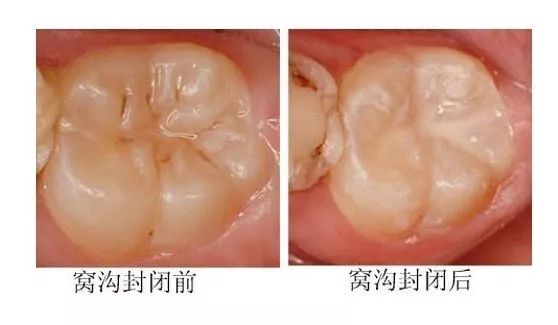 牙齿窝沟封闭是什么意思,牙齿窝沟封闭的含义及其权威诠释推进方式,最新解答解析说明_WP99.10.84