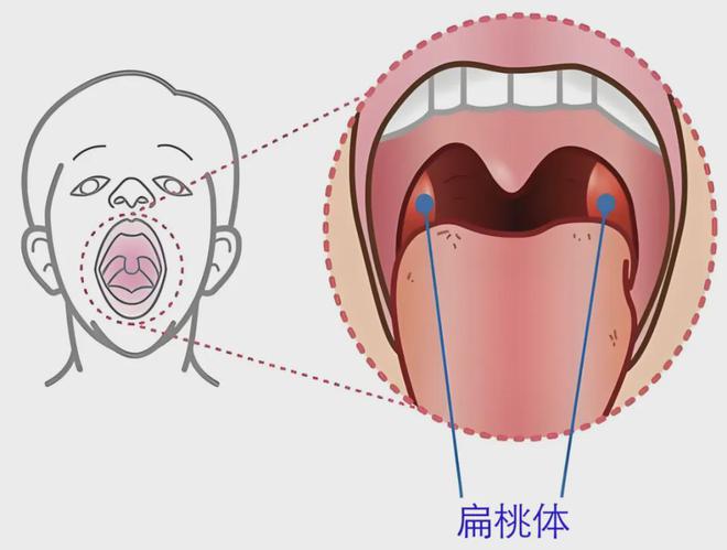 扁桃体发炎吃什么药儿童