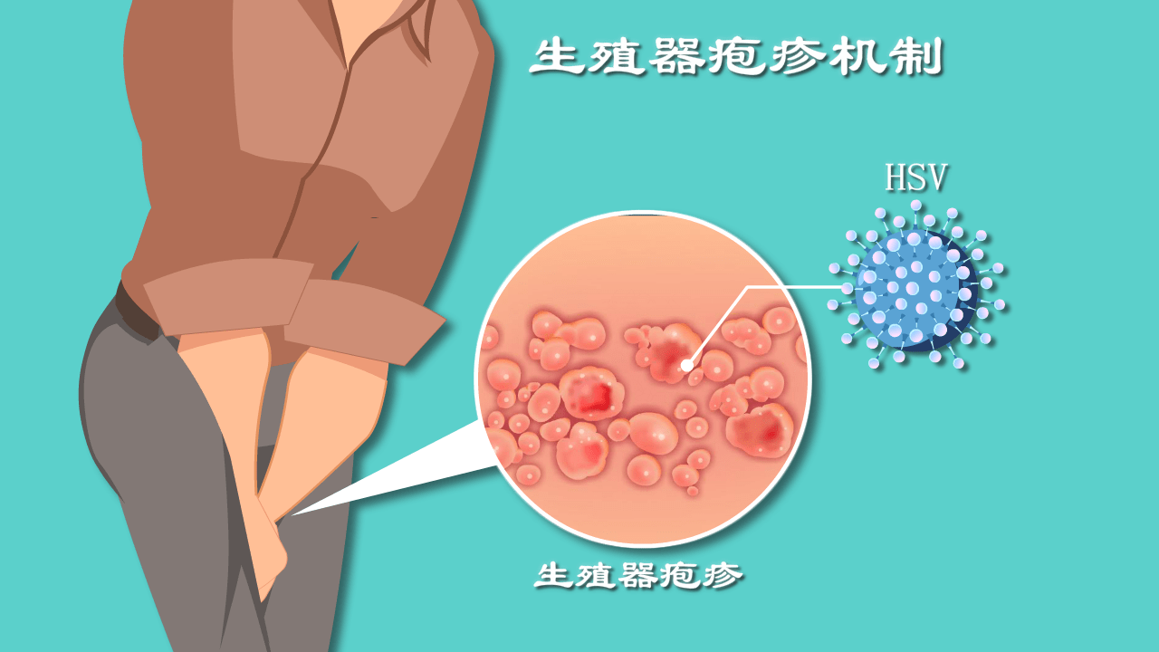 生殖疱疹感染到身上是咋样的,生殖疱疹感染，动态解读与说明,功能性操作方案制定_Executive99.66.67