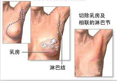 36岁女子摸到胸部疙瘩查出乳腺癌